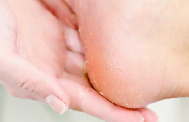 cracked heels